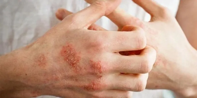 Chàm (eczema) – chẩn đoán và điều trị